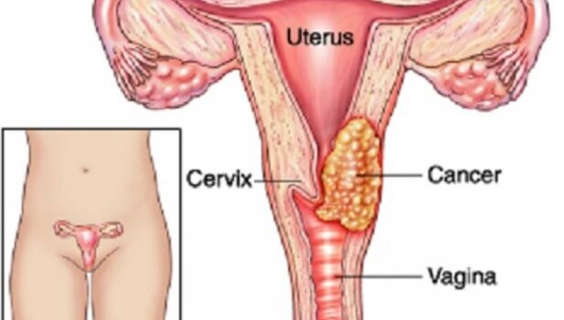Sintomas-de-cancer-de-cuello-uterino.jpg