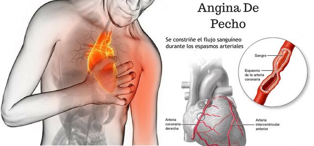 Angina-De-Pecho-1-..-1-1.png