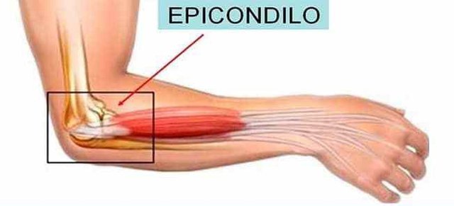 epicondilitis1.jpg