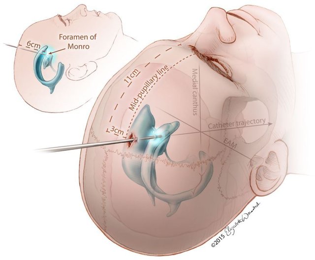 External Ventricular Drain Market1.jpg