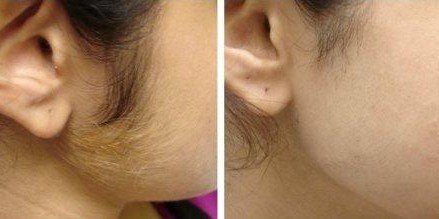 laser-hair-removal-from-face-before-and-after-e1419659401648.jpg