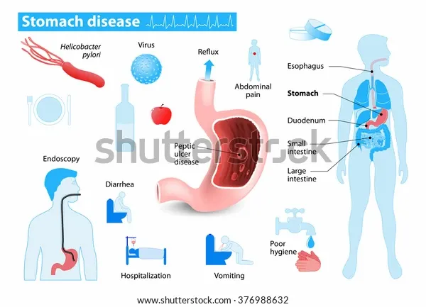 stomach-disease-medical-infographic-set-600w-376988632.webp