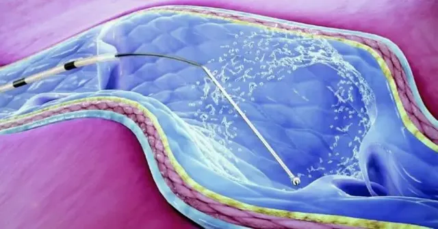 mechanochemical-ablation-clarivein-treatment-inside-the-vein-diagram-768x402.jpg.webp