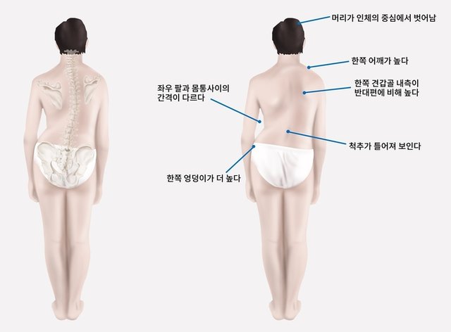 척추측만증 골반에서부터 시작.jpg