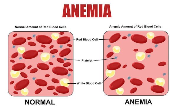 Anaemia-51124045-s.jpg