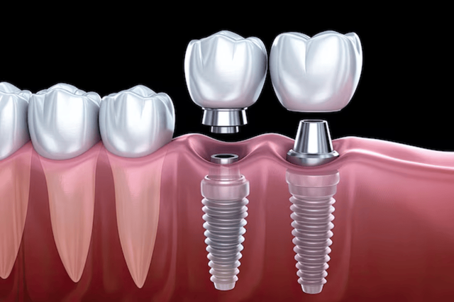 6 Interesting Reasons to Get a Dental Implant.png