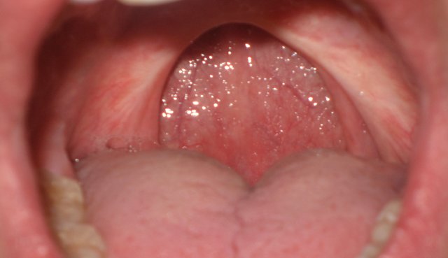 Uvulopalatopharyngoplasty.jpg