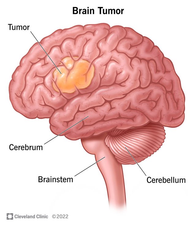 6149-brain-tumor.jpg