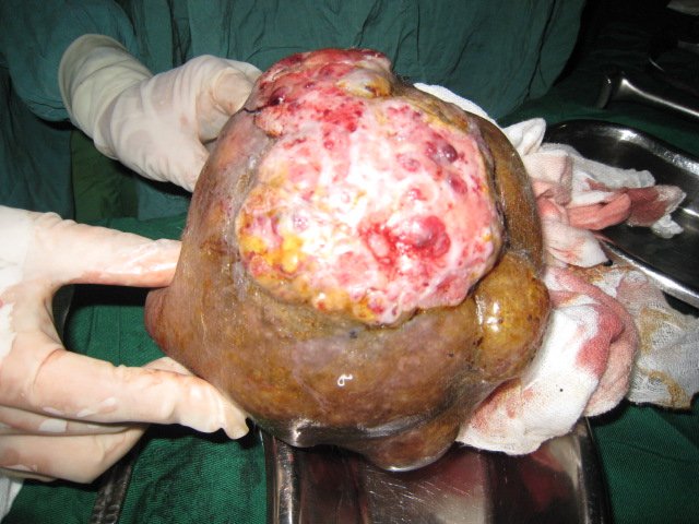 7_Huge_tumor_removed.jpg