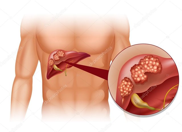 depositphotos_83404170-stock-illustration-liver-cancer-in-human.jpg