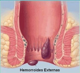 Hemorroides.jpg