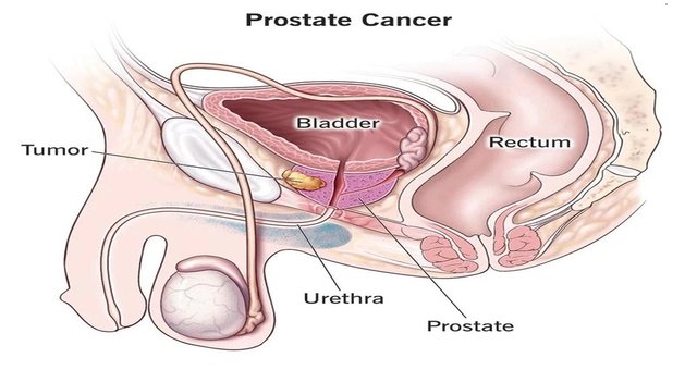 Prostate Cancer.jpg