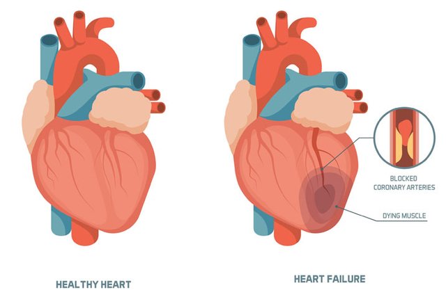 heart-failure5032b07849bf63eeab9aff0f00dba087.jpg