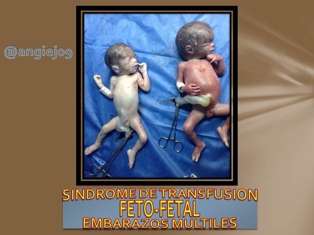 sindrome fetofetal.jpg