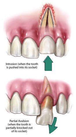 dislodged-teeth.jpg