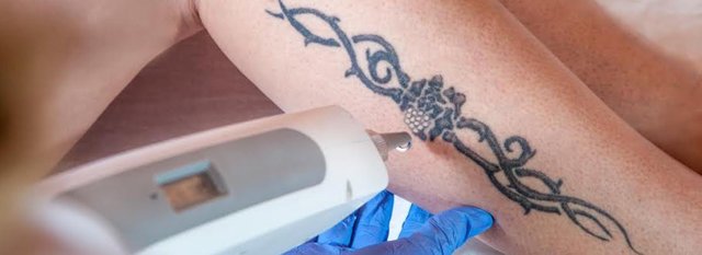 How to Speed Up the Laser Tattoo Removal Process_.jpg
