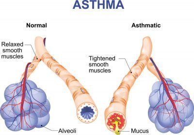 asthma-description-400x279.jpg