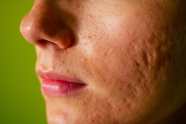 post-acne-scars-red-festering-pimples-face-young-woman-concept-skin-problems-harmonic-failure_175356-2120.jpg