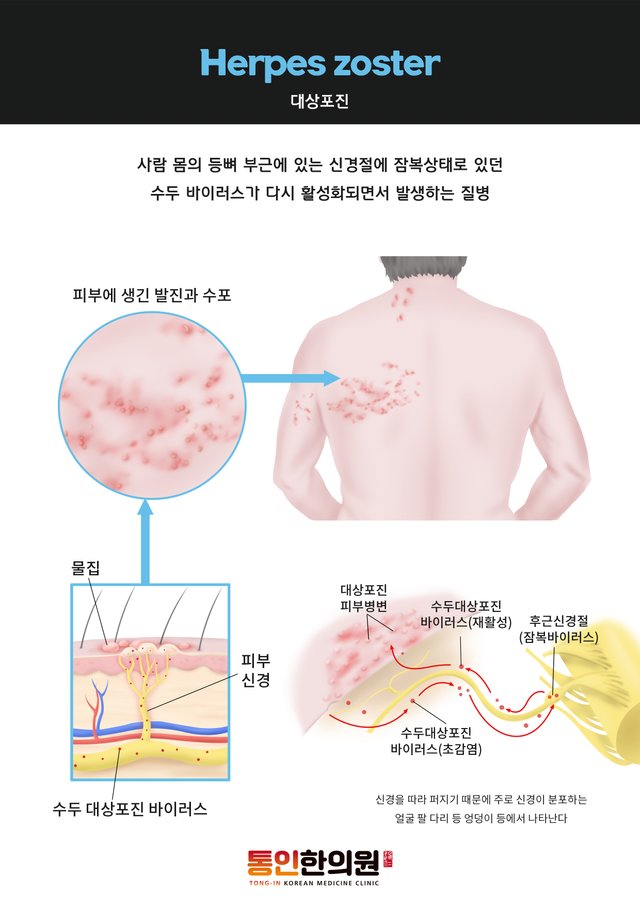 대상포진.jpg