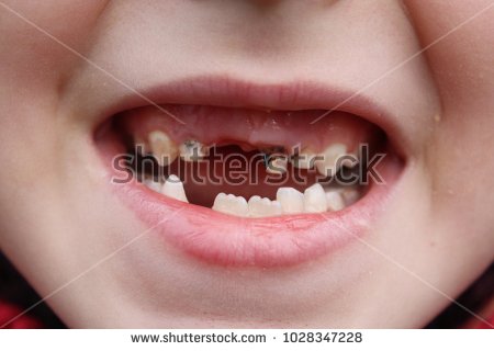 stock-photo-child-s-open-mouth-smiling-problem-in-caries-of-baby-teeth-different-stages-of-disease-this-1028347228.jpg