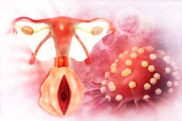 Why Uterine Cancer Isn't Caught Earlier.jpg