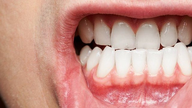 8 Things to Know About Gum Disease.jpg