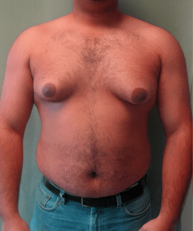 Gynecomastia.png