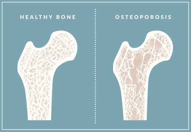 osteoporosis-5856e9513df78ce2c33dea8d.jpg