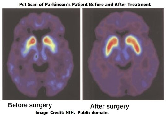 PET scan of parkinsons patient after fetal tissue NIH public.jpg