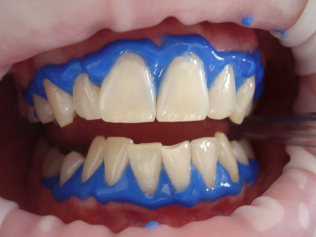 laser-teeth-whitening-g09603d069_1920.jpg