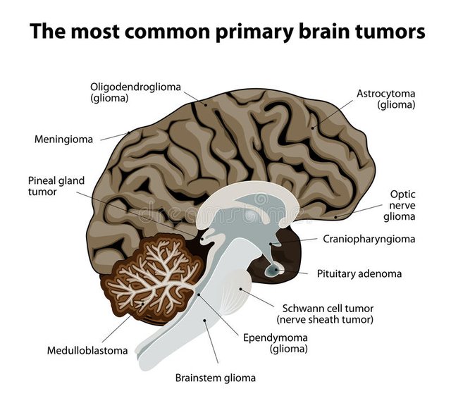 most-common-primary-brain-tumors-different-types-categorized-type-cell-where-tumor-begins-cancer-46768479.jpg