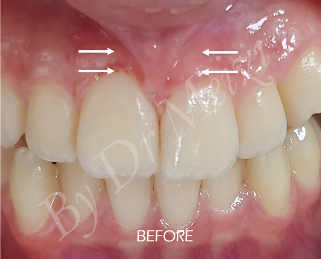 Before Laser Treated Frenectomy.png