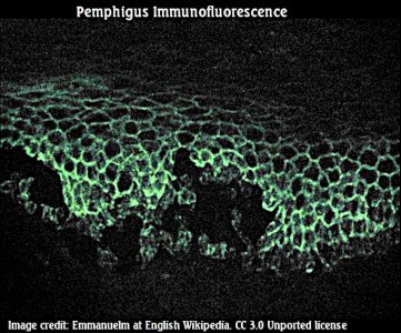 Pemphigus_immunofluorescence2  attr Emmanuelm at english wikipedia 3.0.jpg