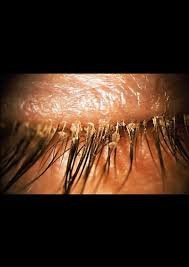 Blepharitis-Pipeline1.jpg