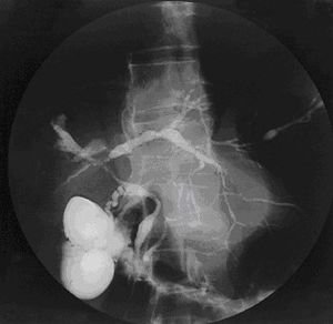 Cholangiogram_of_primary_sclerosing_cholangitis.jpg