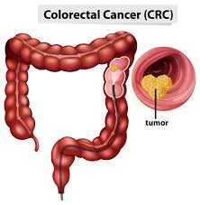 colon pic.jpg