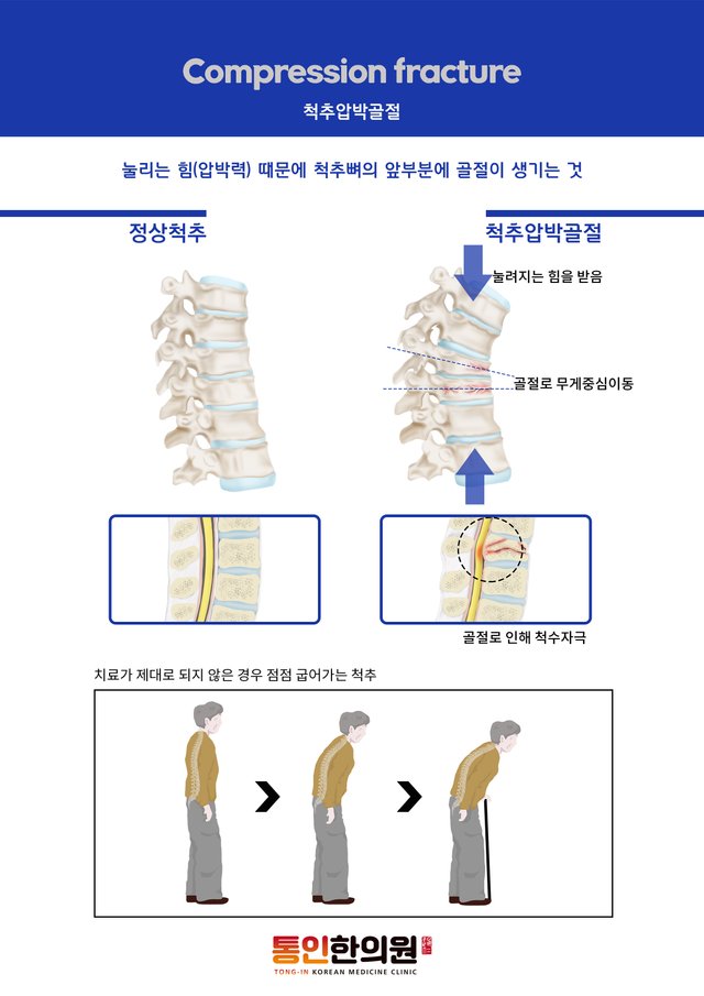 압박골절증상 종로한의원 통인한의원.jpg