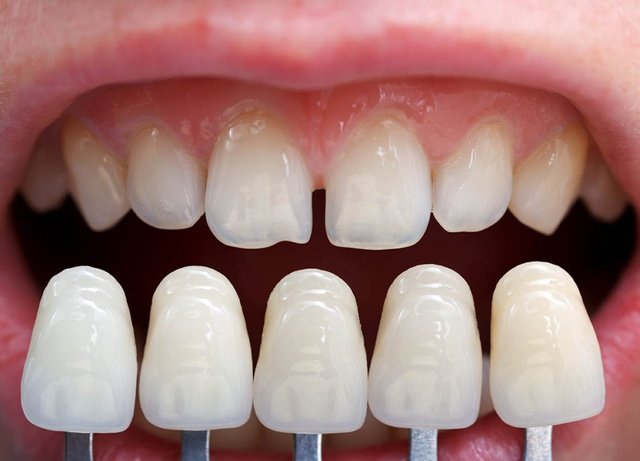 Everything You Should Know About Dental Veneers.jpg