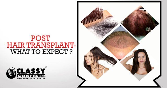 classygraftsindia.com-The-after-effects-of-Hair-Transplant.jpg