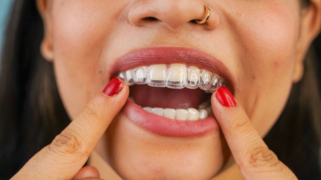 7 Yes For Invisalign Treatment.jpg