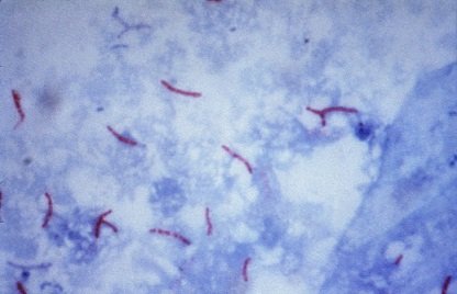 Mycobacterium_tuberculosis_Ziehl-Neelsen_stain_02.jpg
