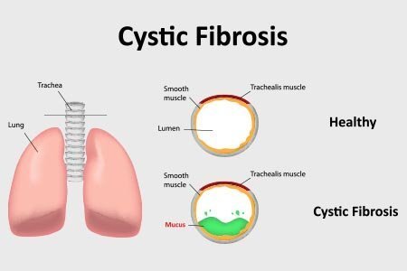 cystic-fibrosis.jpg