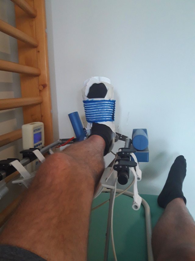 broken ankle - kinetec.jpg