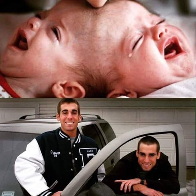 Before-Now-Pictures-of-Conjoined-Twins-Separated-by-Dr.-Ben-Carson-in-1987.jpg
