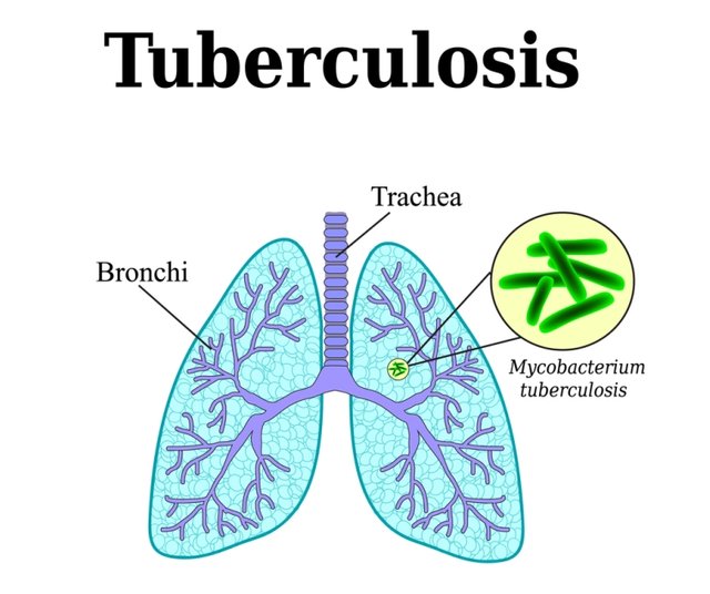 Pulmonary-Tuberculosis.jpg
