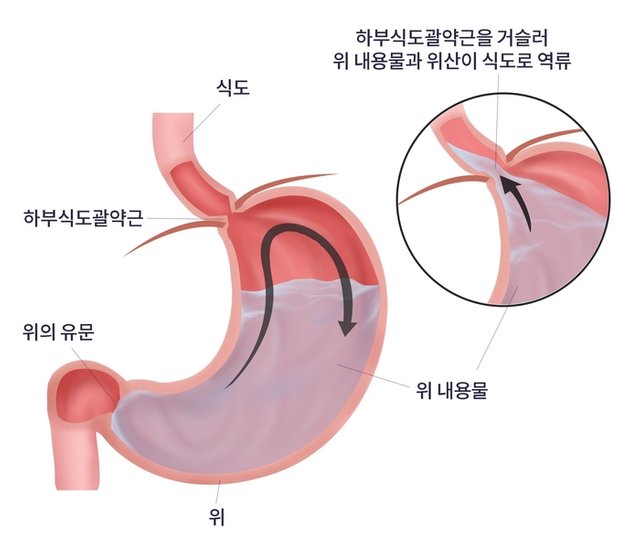 역류성식도염.jpg