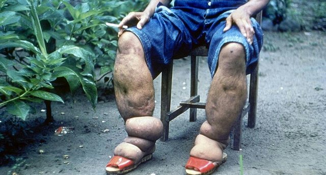 800px-Elephantiasis-1.jpg