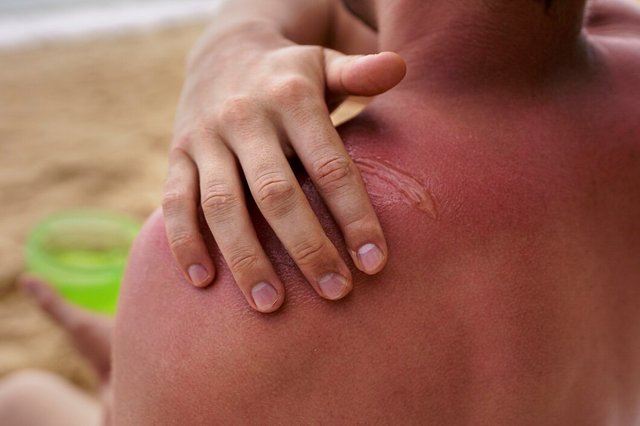 view-man-applying-lotion-sunburn-skin-beach_23-2150282823.jpg