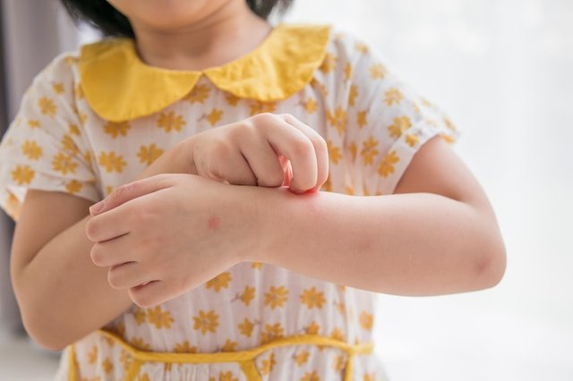 The Secrets To ECZEMA FOR KIDS.jpg