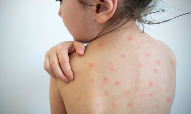 measles-su19.jpg